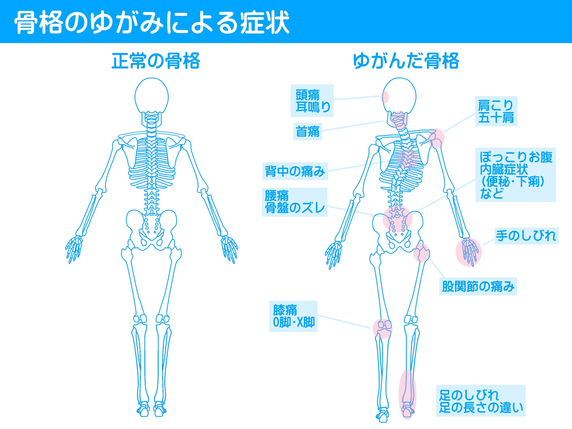 背骨のズレの症状